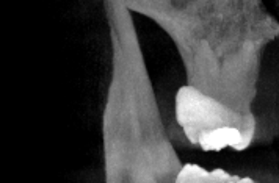Rotating 3D view of the dental CBCT scan
